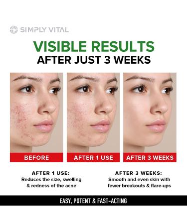 Acne Medication Face Cream - Fast Acting USA-Made Treatment for Stubborn Pimples, Blackheads, Whiteheads - Soothing Moisturizer for Acne Relief & Scar Prevention - 2oz - Buy Online on SooperMarket.com