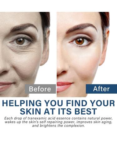 Buy Tranexamic Acid Serum - Discoloration Correcting Face Lotion | Natural Moisturizing Skincare | International Shipping - Buy Online on SooperMarket.com