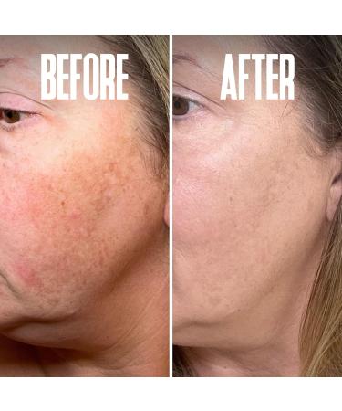 Dark Spot Corrector Serum - Remove Stubborn Dark Spots with Kojic Acid & Alpha Arbutin | Brightening Discoloration Remover for Face - Buy Online on SooperMarket.com