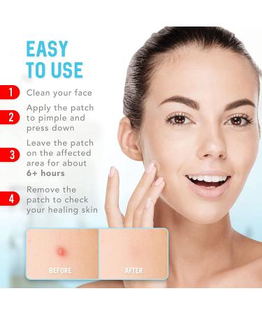 Hydrocolloid Acne Patches (120 Pack) with Tea Tree Oil - Pimple Stickers for Healing Acne - Zit Patch Treatment - Buy Online on SooperMarket.com