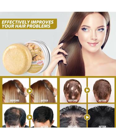Zoreni Ginger Hair Regrowth Shampoo Bar - 5 Pack | Organic Anti Hair Loss Soap | Promotes Hair Growth, Anti-dandruff & Anti-itching | 2.12 Fl Oz - Buy Online on SooperMarket.com