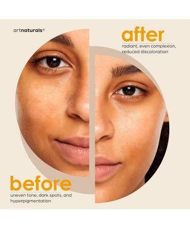 Artnaturals Kojic Acid Soap & African Net Sponge - Dark Spot Remover Scars Treatment (2 Pack x 142g) with Vitamin C Hyaluronic Acid Shea Butter - Citrus Scent - Buy Online on SooperMarket.com