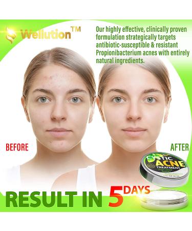 Cystic Acne Treatment & Scar Remover - USA Made Severe Acne Cleanser with Tea Tree Oil - Prevent Breakouts - Natural Pimple Cream - Buy Online on SooperMarket.com