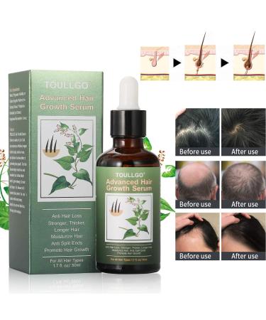 Hair Growth Serum - Thicker Longer Fuller Hair | Prevent Hair Loss & Thinning | Vitamin-Rich Natural Treatment - Shop Now - Buy Online on SooperMarket.com