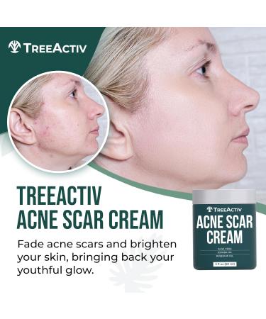 TreeActiv Acne Scar Cream - Effective Treatment for Face & Body Scars Stretch Marks 500+ Uses - All Skin Types - Buy Online on SooperMarket.com