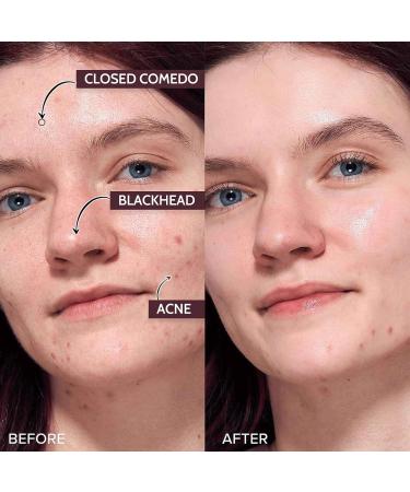 AHA 5% + BH_A 1% Peeling Solution Smooth Skin Exfoliating Facial Serum -Acid Serum For Acne Blackheads & Open Pores Blackhead Remover Reduces Excess Oil & Bumpy Texture 32ml  - Buy Online on SooperMarket.com