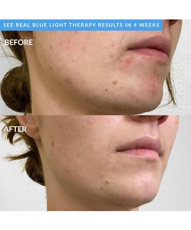 PMD Clean Acne - Smart Facial Cleansing Device with Silicone Brush & Blue Light Treatment for Acne - Waterproof & SonicGlow Technology - Buy Online on SooperMarket.com