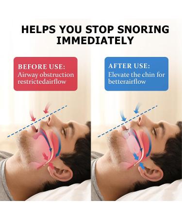 Original Anti-Snoring Mouthpiece - Stop Snoring with Comfort and Adjustable Fit - White - Buy Online on SooperMarket.com