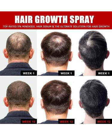 Ceessting Hair Growth Spray - Biotin, Caffeine & Niacinamide - 2oz Anti-Hair Loss & Regrowth Treatment for Men & Women - Buy Online on SooperMarket.com