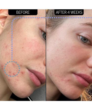 Buy INKEY List SuperSolutions Novoretin 2% Moisturizer - Skin Clearing Blemish Reduction Non-Comedogenic - International Shipping Available - Buy Online on SooperMarket.com