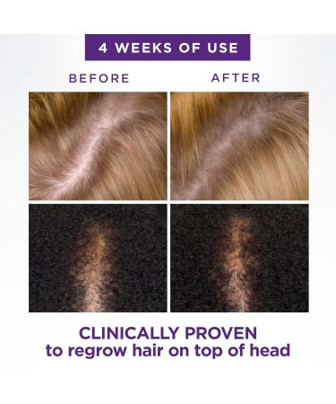 Head & Shoulders Scalp X 2% Minoxidil for Women - Hair Regrowth Treatment Thinning Hair & Hair Loss Solution 3 Month Supply (3 x 2 Fl Oz - Buy Online on SooperMarket.com