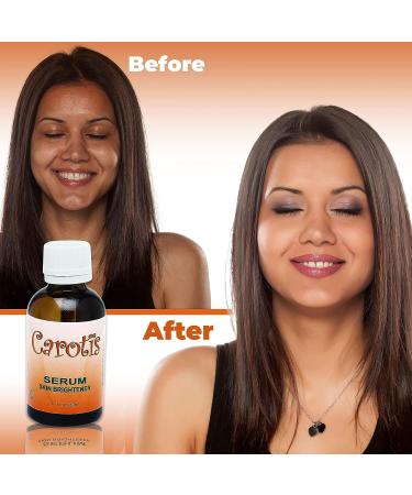 Carotis Brightening Serum 1oz - Fade Brown Spots with Alpha Arbutin & Beta Carotene - Buy Online on SooperMarket.com