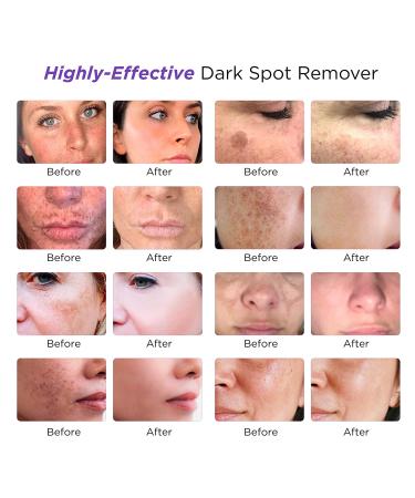 Dark Spot Remover Serum for Face & Body | Age Sun Spots, Freckles, Melasma Treatment | 4-Butylresorcinol, Kojic Acid, Hyaluronic Acid - 50ml - Buy Online on SooperMarket.com