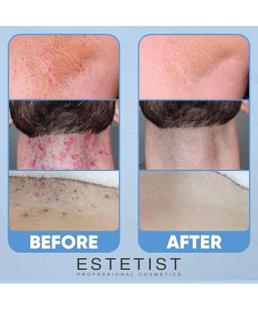 ESTETIST Razor Bump Stopper Solution with Salicylic Acid & Glycolic Acid - Ingrown Hair Treatment for Face, Neck, Bikini, Legs, Underarms - After Shave Serum for Men & Women - Buy Online on SooperMarket.com