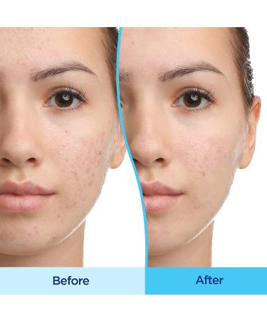 Differin Acne Treatment Gel 45g | Effective Acne Solution & Clear Skin - Buy Online on SooperMarket.com