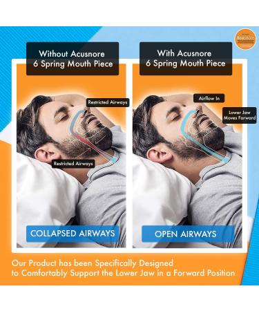 The Original Acusnore Anti Snore 6 Spring Mouth Piece Guard With Anti Bacterial Storage Case Included- Immediate Relief From Apnea Snoring Heaving Breathing & Grinding Teeth- Patented Design - Buy Online on SooperMarket.com