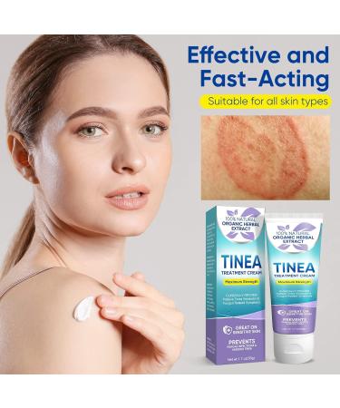 Tinea Versicolor Natural Skin Cream - Effective Treatment for All Skin Types - Buy Online on SooperMarket.com