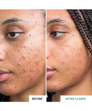 Erborian - Centella Acne Care - Soothing Moisturising Fluid 1% Bakuchiol/Patch Pimple Effect 10% PHA - Acne & Blemish Treatment - Korean Cosmetics - Buy Online on SooperMarket.com
