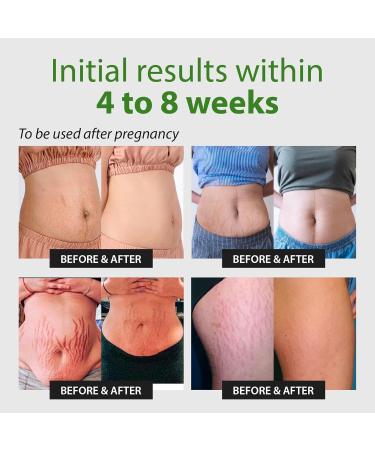 Abera Ovela Maternity Stretch Mark Cream - Effective Treatment for Pregnancy & Weight Fluctuations Deep Mark Removal All Skin Types 1.69 fl oz - Buy Online on SooperMarket.com