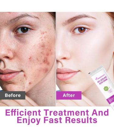 Azelaic Acid Serum Cream 12% Azelaic Acid Cream Redness Relief Face Balance Excess Sebum 20ml - Buy Online on SooperMarket.com