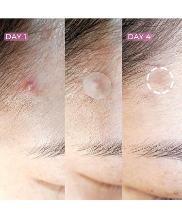 Hanhoo 36 Count Blemish Patch | Hydrocolloid Spot Treatment for Pimples | Acne Cover & Oil Absorption | Cruelty-free & Vegan | Face and Body Zits Treatment - Buy Online on SooperMarket.com