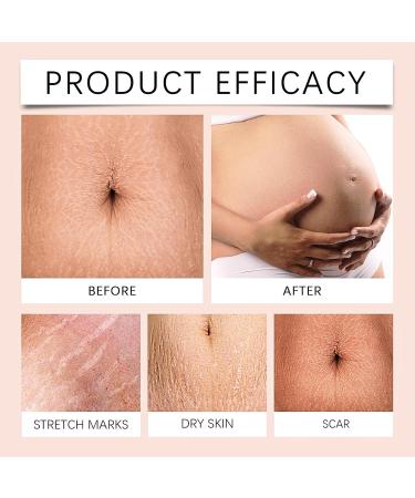 Stretch Marks Removal Pregnancy Stretch Mark Cream Anti Stretch Marks Body Cream for Women Scar Removal Cream Maternity Repair Moisturising Cream & Softening Mild & Caring - Buy Online on SooperMarket.com