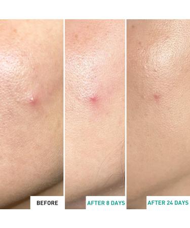 Erborian - Centella Acne Care - Soothing Moisturising Fluid 1% Bakuchiol/Patch Pimple Effect 10% PHA - Acne & Blemish Treatment - Korean Cosmetics - Buy Online on SooperMarket.com