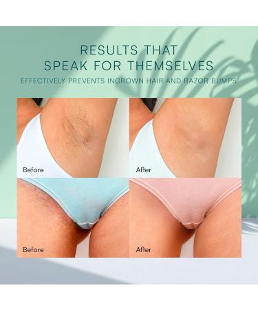 Intimate Ingrown Hair Treatment Kit - Bikini Bump Blaster & Razor Bump Solution - Buy Online on SooperMarket.com