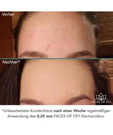 Microneedling Set Faces of Fey - 192 Real Needles Dermaroller Hyaluron Serum & Sanitizer - 0.5mm Nadel Roller for Face & Body Tightening & Modeling - Buy Online on SooperMarket.com