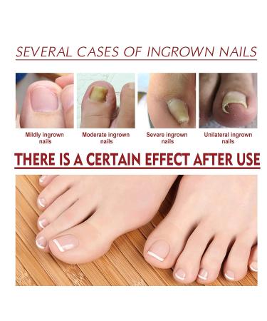 Top Nail Fungus Treatment: German ToenailPlus Kaluofan & More Effective Anti Paronychia Relief & Nail Care - Buy Online on SooperMarket.com
