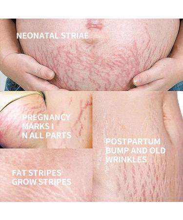 Best Stretch Mark Cream for Pregnancy | Tummy Butter & Belly Butter for Prevention & Repair - Buy Online on SooperMarket.com