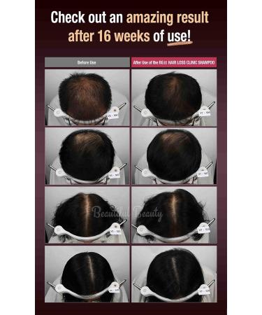 RG3 Premium Hair Loss Clinic Shampoo + Eco Clinic Therapy Treatment - Hair Regrowth with Red Ginseng and Argan Oil - 520ml + 160ml - Buy Online on SooperMarket.com