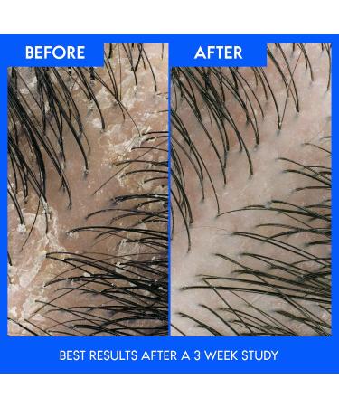 Head & Shoulders Itchy Scalp 2-in-1 Shampoo + Conditioner 613ML - Buy Online on SooperMarket.com
