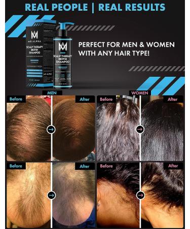 MR ALPHA Dry Scalp Biotin Shampoo for Hair Loss & Thinning - Men & Women - DHT Blocking Formula - Hair Growth & Thickening Treatment - Buy Online on SooperMarket.com