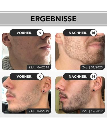 Anthony Brown Oil Beard Growth Kit | Money Back Guarantee | Tabed Effect for Enhanced Beard Growth | Bart Warser Men s Roller 0.5mm - Buy Online on SooperMarket.com