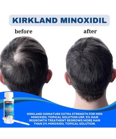 Kirkland Minoxidil 5% Extra Strength 6 Month Supply for Men - Hair Regrowth Treatment - 2 Fl Oz (Pack of 6) + Bonus Key Chain - Buy Online on SooperMarket.com