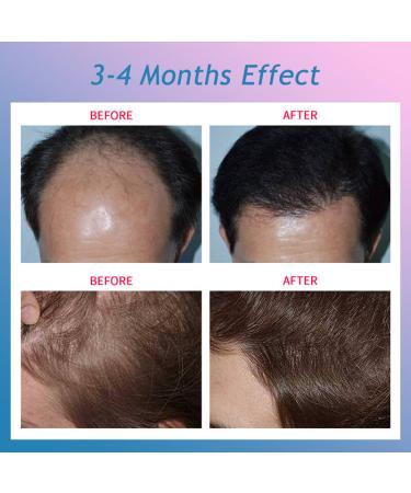 CNV Laser Hair Growth Helmet System - White - Buy Online on SooperMarket.com
