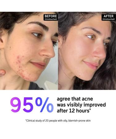 Shop The INKEY List Succinic Acid Acne Treatment - 0.5 oz/ 15 mL Online - Best Price & International Shipping - Buy Online on SooperMarket.com