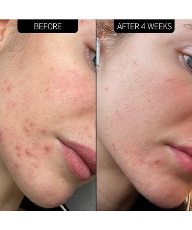 Shop The INKEY List SuperSolutions Acne Clearing Moisturizer 2% NOVORETIN - 1.7 oz / 50 ml Online - Best Price & International Shipping - Buy Online on SooperMarket.com