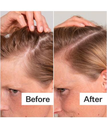 Shop Act+Acre Salicylic Acid Scalp Renew Exfoliator For Oily + Flakey Scalp - 2 oz / 60 ml Online - Best Price & International Shipping - Buy Online on SooperMarket.com