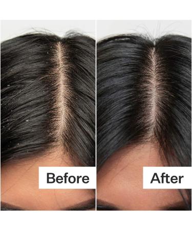 Shop Act+Acre Salicylic Acid Scalp Renew Exfoliator For Oily + Flakey Scalp - 2 oz / 60 ml Online - Best Price & International Shipping - Buy Online on SooperMarket.com