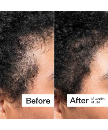 Shop Act+Acre 0.25mm Scalp Dermaroller for Thicker + Fuller Looking Hair - Standard size Online - Best Price & International Shipping - Buy Online on SooperMarket.com