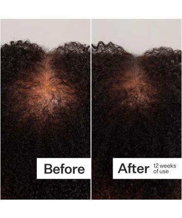 Shop Act+Acre 0.25mm Scalp Dermaroller for Thicker + Fuller Looking Hair - Standard size Online - Best Price & International Shipping - Buy Online on SooperMarket.com