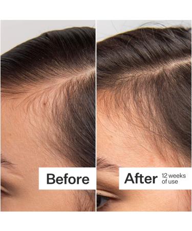 Shop Act+Acre 0.25mm Scalp Dermaroller for Thicker + Fuller Looking Hair - Standard size Online - Best Price & International Shipping - Buy Online on SooperMarket.com