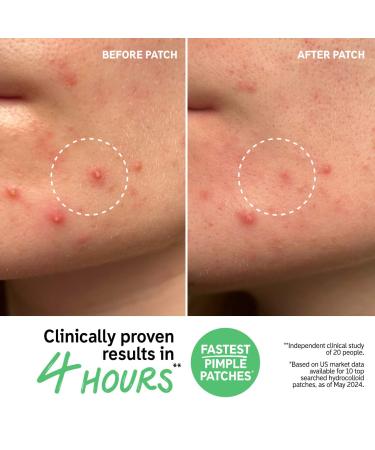 Shop The INKEY List Hydrocolloid Invisible Pimple Patches + Salicylic Acid Online - Best Price & International Shipping - Buy Online on SooperMarket.com