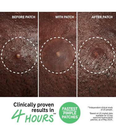 Shop The INKEY List Hydrocolloid Invisible Pimple Patches + Salicylic Acid Online - Best Price & International Shipping - Buy Online on SooperMarket.com