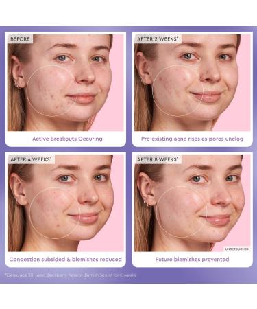Shop Glow Recipe Blackberry Retinol Blemish Serum - 1 oz / 30 ml Online - Best Price & International Shipping - Buy Online on SooperMarket.com