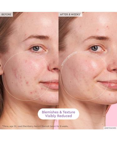 Shop Glow Recipe Blackberry Retinol Blemish Serum - 1 oz / 30 ml Online - Best Price & International Shipping - Buy Online on SooperMarket.com