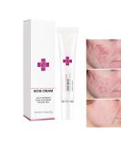 Onkessy Repair Acne Cream - Pimple Treatment for Men and Women - Hydrating & Oil Control Formula for Quick Acne Removal - Buy Online on SooperMarket.com