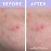 florence by mills Spot a Spot Acne Patches 36 ct - Discover Premium Quality Shop now! - Buy Online on SooperMarket.com